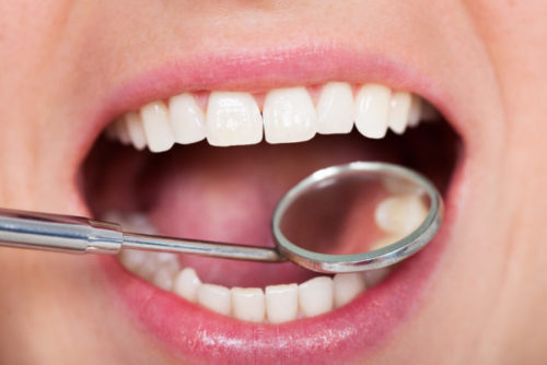 Dental Inspection | Kedron Family Dental