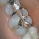 Cracked Teeth | Kedron Family Dental