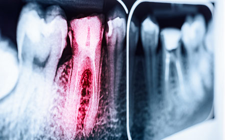 Endodontics and Root Canal | Kedron Family Dental