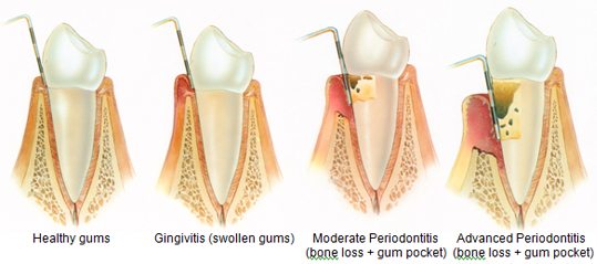 periodontal treatment | Kedron Family Dental